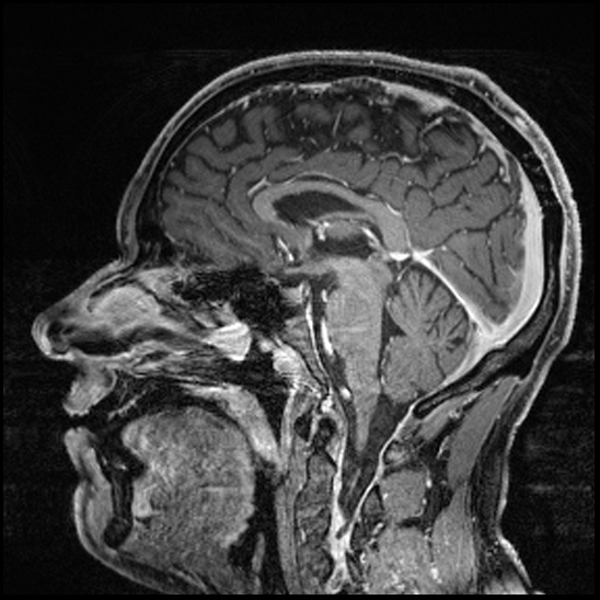 Cerebral abscess with ventriculitis (Radiopaedia 78965-91878 Sagittal T1 C+ 89).jpg