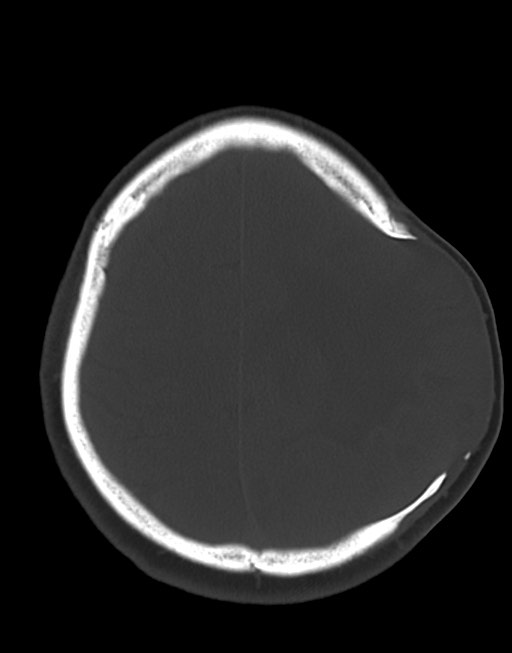 Cerebral abscesses (Radiopaedia 70458-80568 Axial bone window 47).jpg
