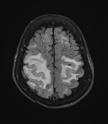 File:Cerebral amyloid angiopathy-related inflammation (Radiopaedia 74836-85849 Axial FLAIR 23).jpg