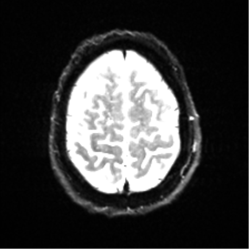 Cerebral amyloid angiopathy (Radiopaedia 46082-50433 Axial DWI 23).png
