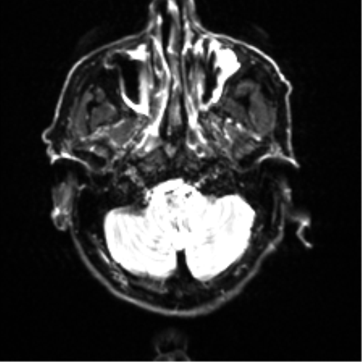 Cerebral amyloid angiopathy (Radiopaedia 46082-50433 Axial DWI 3).png