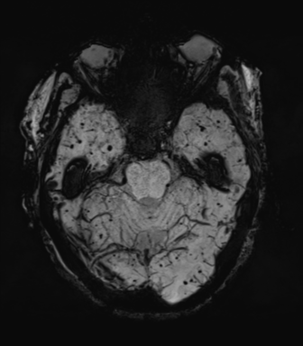 File:Cerebral amyloid angiopathy (Radiopaedia 46082-50433 Axial SWI MIP 23).png