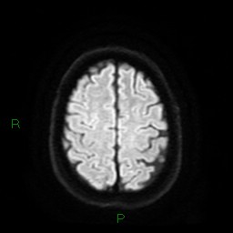 File:Cerebral amyloid angiopathy (Radiopaedia 77506-89664 Axial DWI 23).jpg