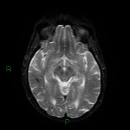 Cerebral amyloid angiopathy (Radiopaedia 77506-89664 Axial DWI 41).jpg