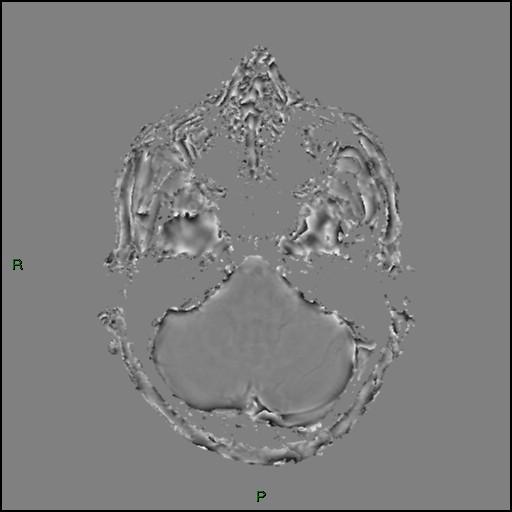 Cerebral amyloid angiopathy (Radiopaedia 77506-89664 H 26).jpg