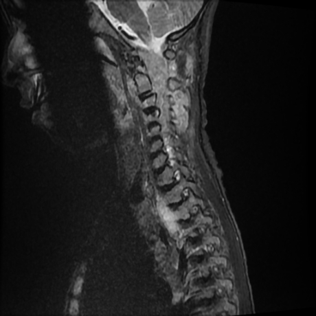 File:Cerebral and spinal tuberculosis (Radiopaedia 90489-107838 Sagittal STIR 9).jpg