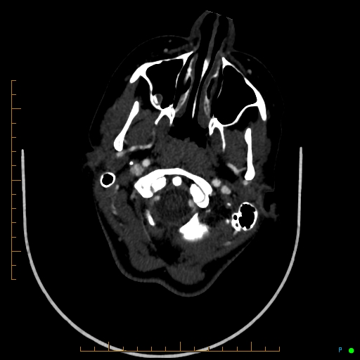 Cerebral arteriovenous malformation (AVM) (Radiopaedia 78162-90706 Axial CTA 42).jpg