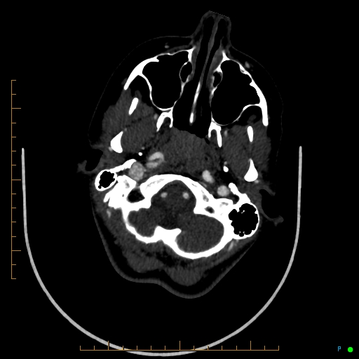 Cerebral arteriovenous malformation (AVM) (Radiopaedia 78162-90706 Axial CTA 51).jpg