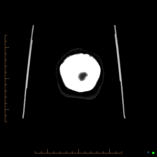 Cerebral arteriovenous malformation (AVM) (Radiopaedia 78162-90706 Coronal CTA 6).jpg