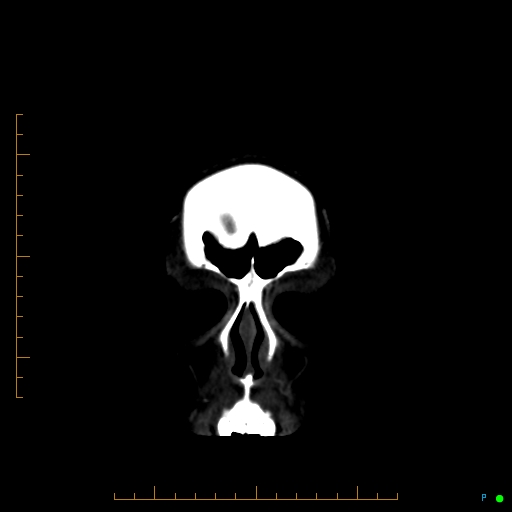 Cerebral arteriovenous malformation (AVM) (Radiopaedia 78162-90706 Coronal CTA 94).jpg