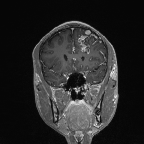 Cerebral arteriovenous malformation (Radiopaedia 30198-30813 F 22).jpg