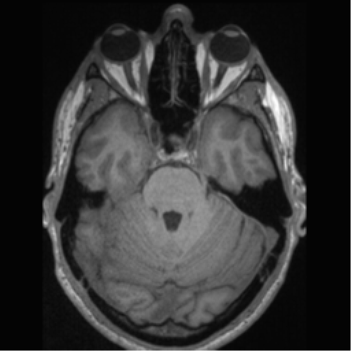 Cerebral arteriovenous malformation (Radiopaedia 55798-62372 Axial T1 18).png
