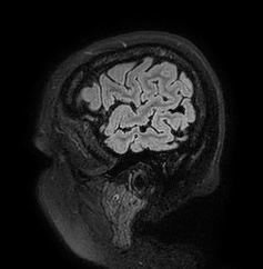 Cerebral arteriovenous malformation (Radiopaedia 74411-85654 Sagittal FLAIR 11).jpg