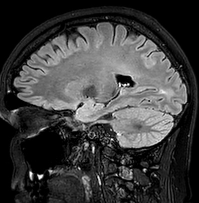 File:Cerebral arteriovenous malformation (Radiopaedia 74411-85746 Sagittal FLAIR 40).jpg