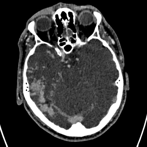 Cerebral arteriovenous malformation (Radiopaedia 78188-90746 Axial C+ delayed 60).jpg