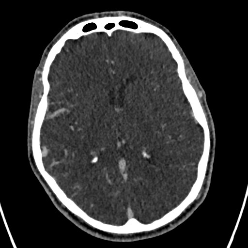 Cerebral arteriovenous malformation (Radiopaedia 78188-90746 Axial C+ delayed 91).jpg