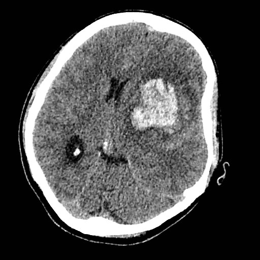 Cerebral arteriovenous malformation (Radiopaedia 79677-92887 Axial non-contrast 18).jpg