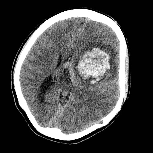 Cerebral arteriovenous malformation (Radiopaedia 79677-92887 Axial non-contrast 21).jpg