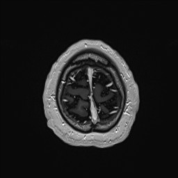 Cerebral arteriovenous malformation (Radiopaedia 84015-99245 Axial T1 C+ 141).jpg