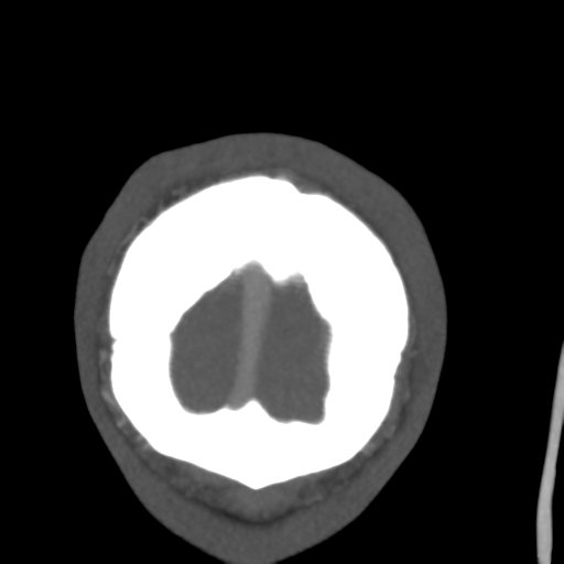 Cerebral arteriovenous malformation (Spetzler-Martin grade 2) (Radiopaedia 41262-44076 F 64).png