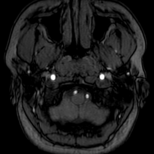 Cerebral arteriovenous malformation at posterior body of corpus callosum (Radiopaedia 74111-84925 Axial MRA 5).jpg