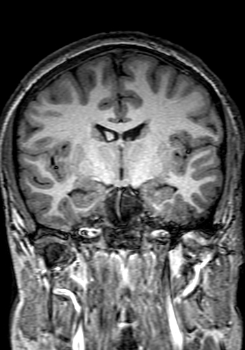 Cerebral arteriovenous malformation at posterior body of corpus callosum (Radiopaedia 74111-84925 Coronal T1 156).jpg
