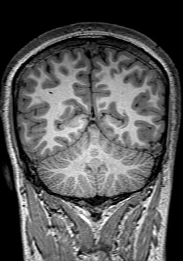 Cerebral arteriovenous malformation at posterior body of corpus callosum (Radiopaedia 74111-84925 Coronal T1 258).jpg
