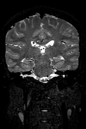 Cerebral arteriovenous malformation at posterior body of corpus callosum (Radiopaedia 74111-84925 Coronal T2 102).jpg