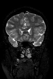 Cerebral arteriovenous malformation at posterior body of corpus callosum (Radiopaedia 74111-84925 Coronal T2 52).jpg