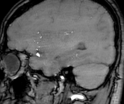 Cerebral arteriovenous malformation at posterior body of corpus callosum (Radiopaedia 74111-84925 J 94).jpg