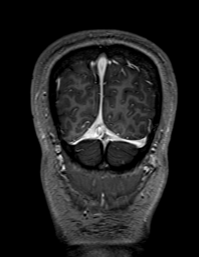 Cerebral arteriovenous malformation at posterior body of corpus callosum (Radiopaedia 74111-84925 K 341).jpg