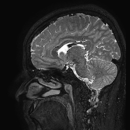 Cerebral arteriovenous malformation at posterior body of corpus callosum (Radiopaedia 74111-84925 Sagittal T2 74).jpg
