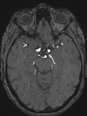 Cerebral arteriovenous malformation with hemorrhage (Radiopaedia 34422-35737 Axial MRA 32).png
