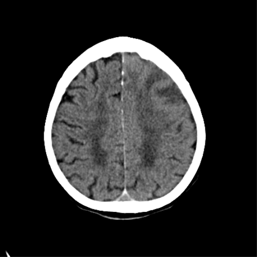File:Cerebral arteriovenous malformation with lobar hemorrhage (Radiopaedia 44725-48510 Axial non-contrast 30).png