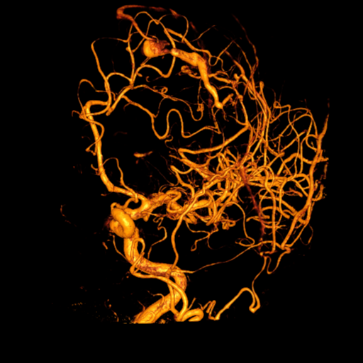 Cerebral arteriovenous malformation with lobar hemorrhage (Radiopaedia 44725-48513 C 40).png
