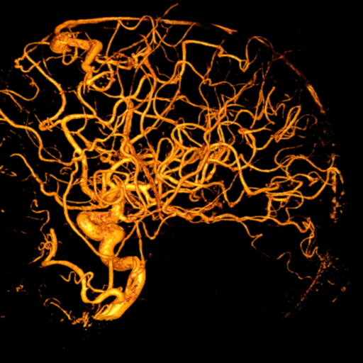 Cerebral arteriovenous malformation with lobar hemorrhage (Radiopaedia 44725-48513 Lateral 52).png