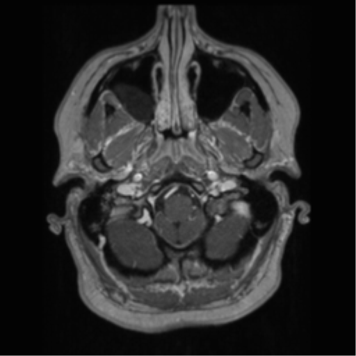 Cerebral cavernoma and development venous anomaly (Radiopaedia 37603-39482 Axial T1 C+ 11).png