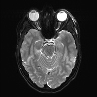 Cerebral cavernous venous malformation (Radiopaedia 70008-80021 Axial DWI 11).jpg
