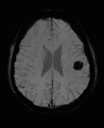 Cerebral cavernous venous malformation (Radiopaedia 70008-80021 Axial SWI 46).jpg