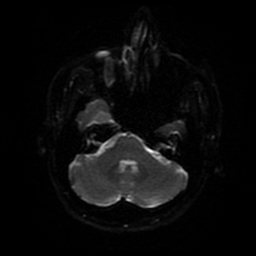 File:Cerebral cavernous venous malformation (Zabramski type II) (Radiopaedia 85511-101198 Axial DWI 75).jpg