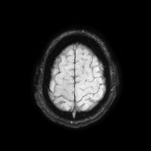 Cerebral cavernous venous malformation (Zabramski type II) (Radiopaedia 85511-101198 Axial SWI 102).jpg