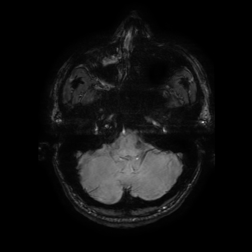 Cerebral cavernous venous malformation (Zabramski type II) (Radiopaedia 85511-101198 Axial SWI 26).jpg
