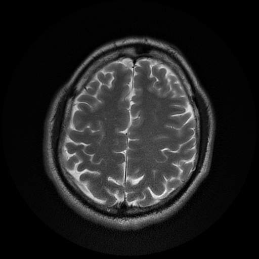 File:Cerebral cavernous venous malformation (Zabramski type II) (Radiopaedia 85511-101198 Axial T2 24).jpg