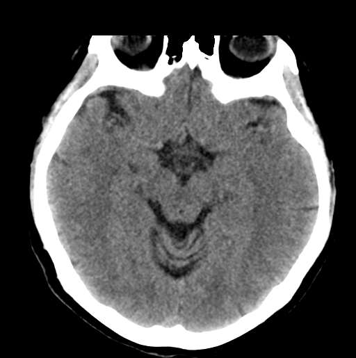 File:Cerebral cavernous venous malformations (Radiopaedia 48117-52945 Axial non-contrast 14).png
