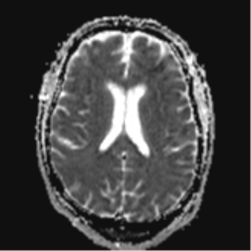 File:Cerebral embolic infarcts (embolic shower) (Radiopaedia 57395-64342 Axial ADC 22).png