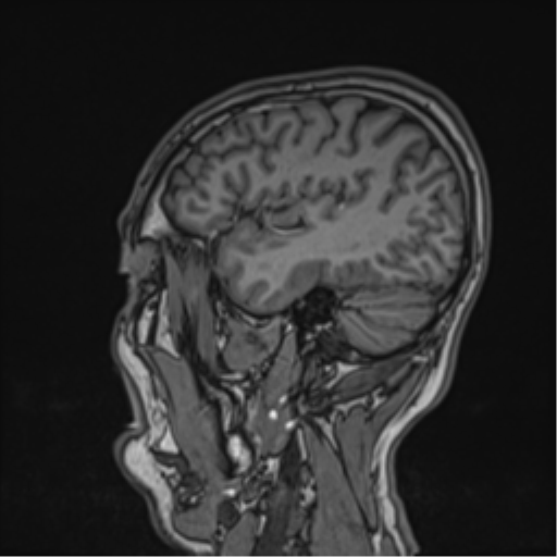 File:Cerebral fat embolism (Radiopaedia 57697-64639 Sagittal T1 16).png