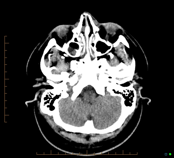 Cerebral fat embolism (Radiopaedia 85521-101224 Axial non-contrast 9).jpg