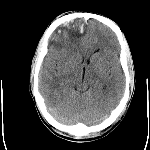 File:Cerebral hemorrhagic contusions- temporal evolution (Radiopaedia 40224-42754 Axial non-contrast 12).png