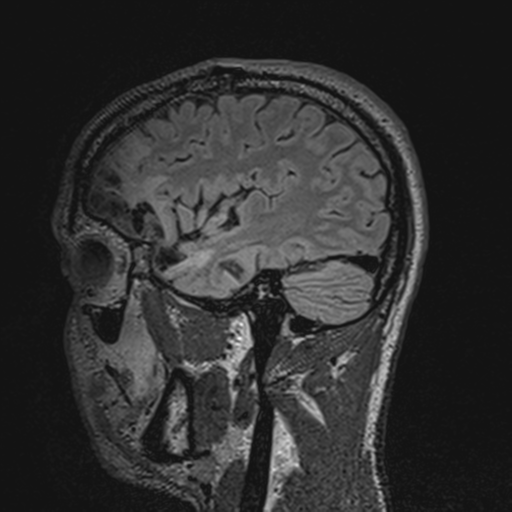File:Cerebral hemorrhagic contusions- temporal evolution (Radiopaedia 40224-42757 Sagittal T1 61).png