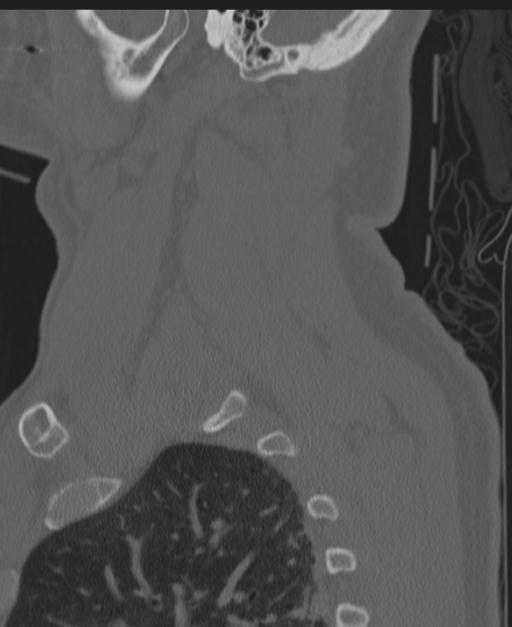 Cerebral hemorrhagic contusions and cervical spine fractures (Radiopaedia 32865-33841 Sagittal bone window 84).jpg
